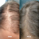 MEDix™ | Κλινικά αποδεδειγμένο ότι ενισχύει την ανάπτυξη των μαλλιών σας (1+1 ΔΩΡΕΑΝ)